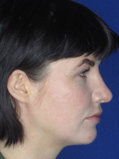 Rhinoplasty Before & After Gallery - Patient 165413270 - Image 2