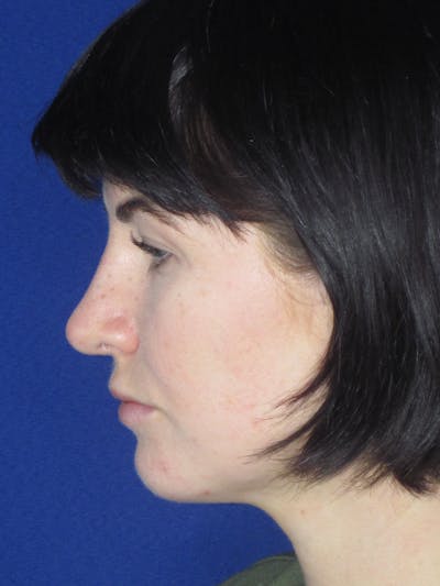 Rhinoplasty Before & After Gallery - Patient 165413270 - Image 6