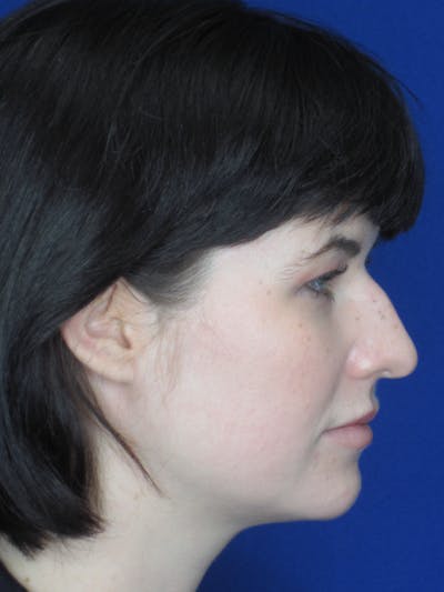 Rhinoplasty Before & After Gallery - Patient 165413270 - Image 1