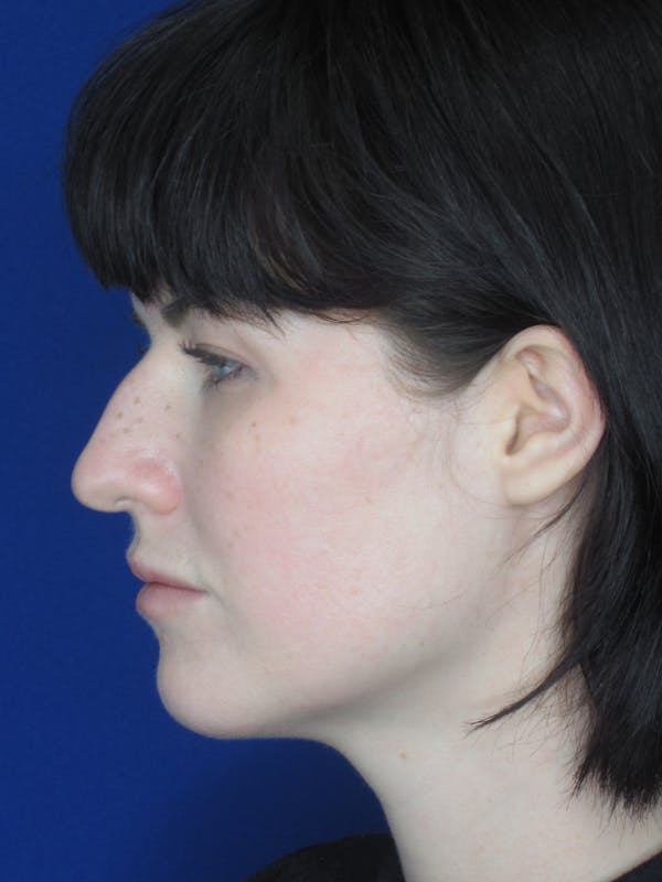Rhinoplasty Before & After Gallery - Patient 165413270 - Image 5