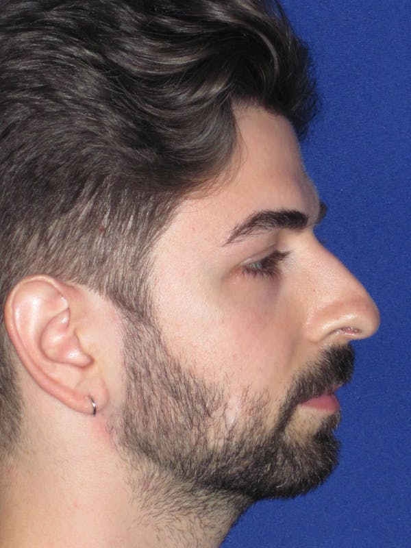 Rhinoplasty Before & After Gallery - Patient 165413304 - Image 1