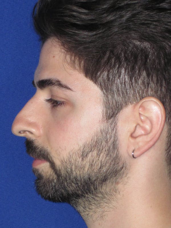 Rhinoplasty Before & After Gallery - Patient 165413304 - Image 7