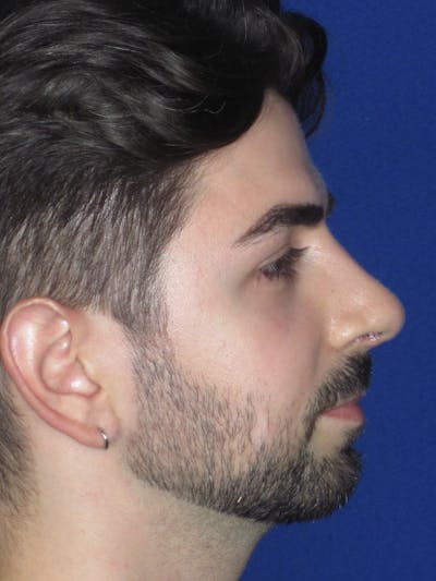 Rhinoplasty Before & After Gallery - Patient 165413304 - Image 2