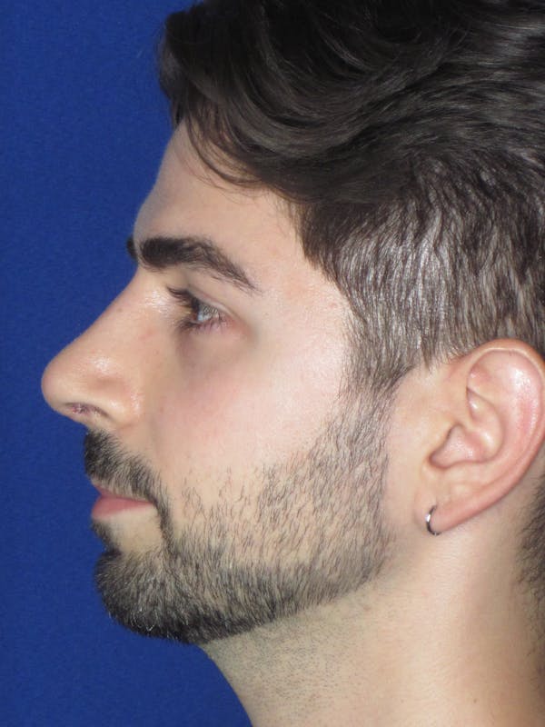 Rhinoplasty Before & After Gallery - Patient 165413304 - Image 8