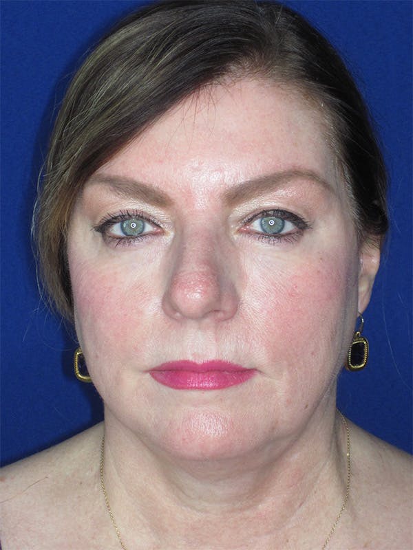 Facelift/Mini-Facelift Before & After Gallery - Patient 165202945 - Image 1