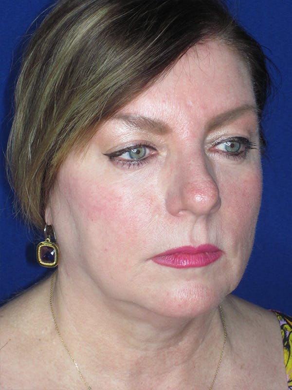 Facelift/Mini-Facelift Before & After Gallery - Patient 165202945 - Image 7