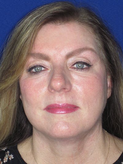 Facelift/Mini-Facelift Before & After Gallery - Patient 165202945 - Image 2