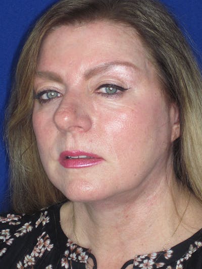 Facelift/Mini-Facelift Before & After Gallery - Patient 165202945 - Image 4