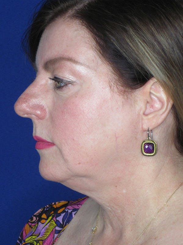 Facelift/Mini-Facelift Before & After Gallery - Patient 165202945 - Image 5
