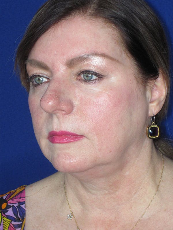 Facelift/Mini-Facelift Before & After Gallery - Patient 165202945 - Image 3