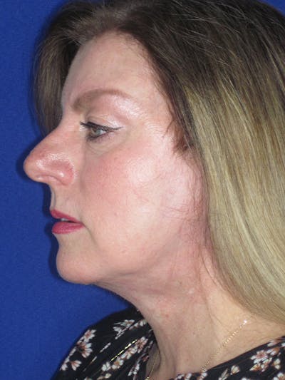 Facelift/Mini-Facelift Before & After Gallery - Patient 165202945 - Image 6