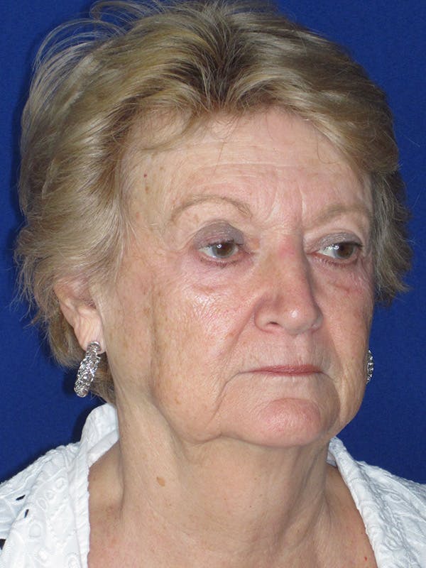 Facelift/Mini-Facelift Before & After Gallery - Patient 165202948 - Image 3
