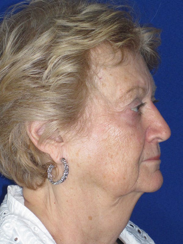 Facelift/Mini-Facelift Before & After Gallery - Patient 165202948 - Image 5