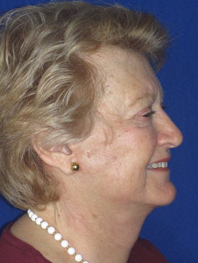 Facelift/Mini-Facelift Before & After Gallery - Patient 165202948 - Image 6