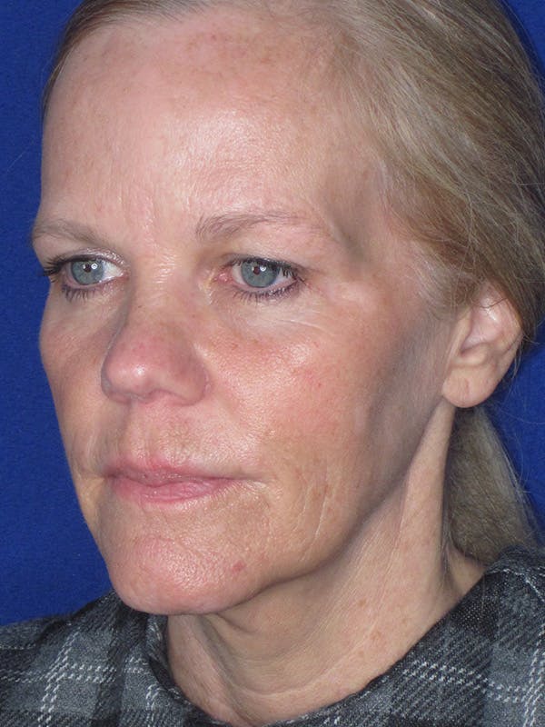Facelift/Mini-Facelift Before & After Gallery - Patient 165202954 - Image 5