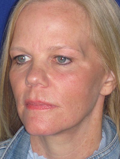 Facelift/Mini-Facelift Before & After Gallery - Patient 165202954 - Image 6