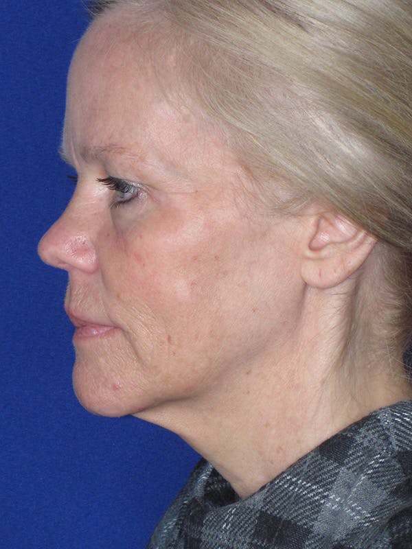 Facelift/Mini-Facelift Before & After Gallery - Patient 165202954 - Image 3