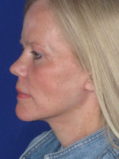 Facelift/Mini-Facelift Before & After Gallery - Patient 165202954 - Image 4