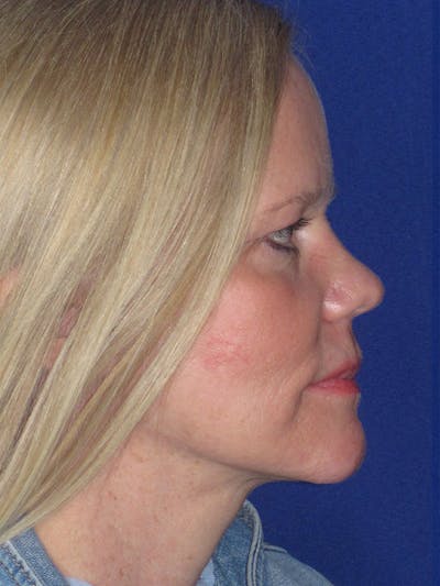 Facelift/Mini-Facelift Before & After Gallery - Patient 165202954 - Image 8