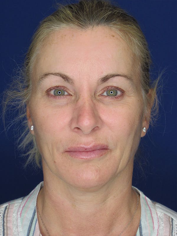 Facelift/Mini-Facelift Before & After Gallery - Patient 165410925 - Image 3
