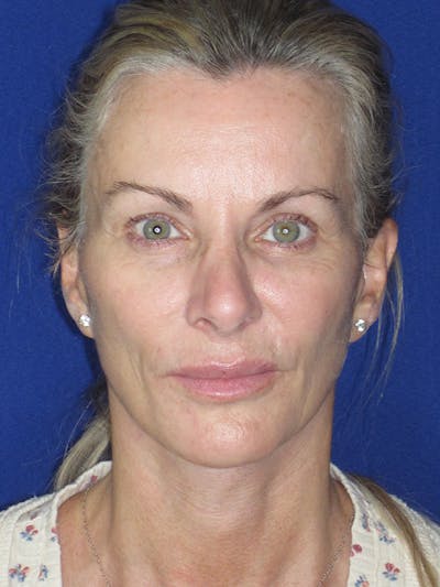 Facelift/Mini-Facelift Before & After Gallery - Patient 165410925 - Image 4