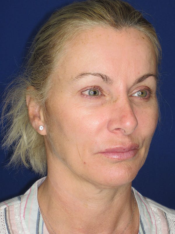 Facelift/Mini-Facelift Before & After Gallery - Patient 165410925 - Image 5