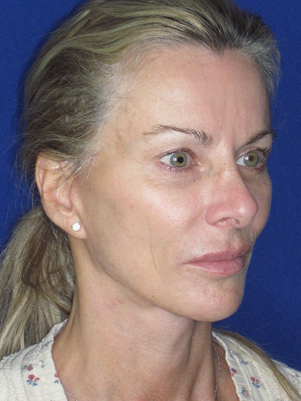 Facelift/Mini-Facelift Before & After Gallery - Patient 165410925 - Image 6