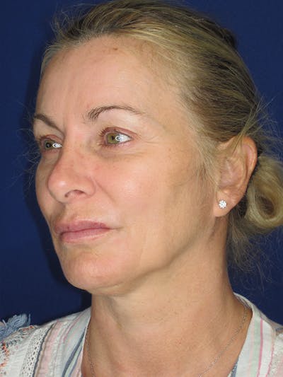 Facelift/Mini-Facelift Before & After Gallery - Patient 165410925 - Image 2