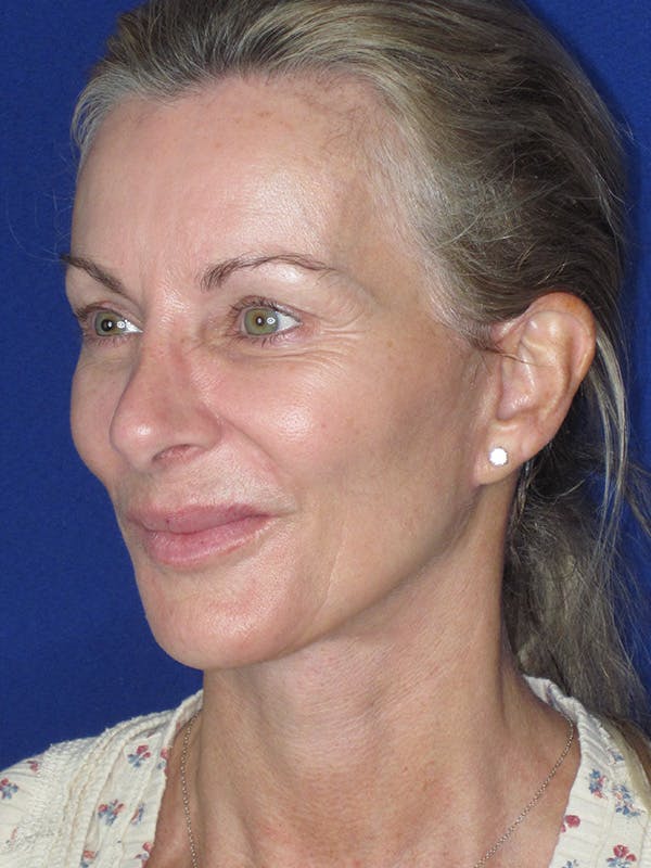 Facelift/Mini-Facelift Before & After Gallery - Patient 165410925 - Image 1