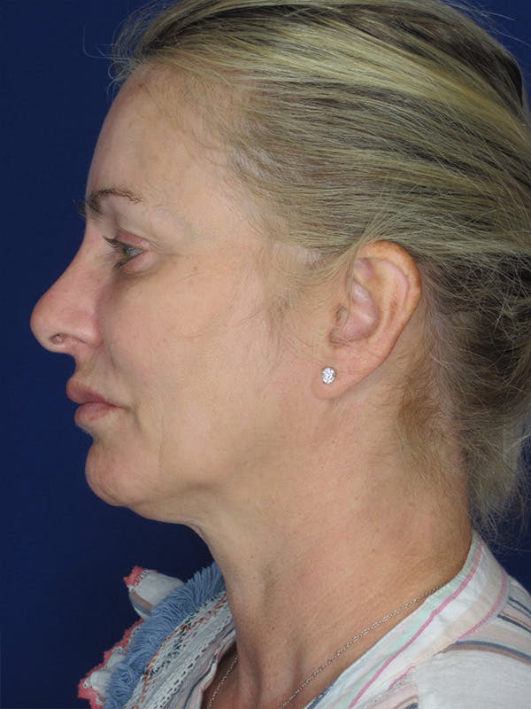 Facelift/Mini-Facelift Before & After Gallery - Patient 165410925 - Image 7