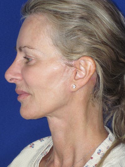 Facelift/Mini-Facelift Before & After Gallery - Patient 165410925 - Image 8