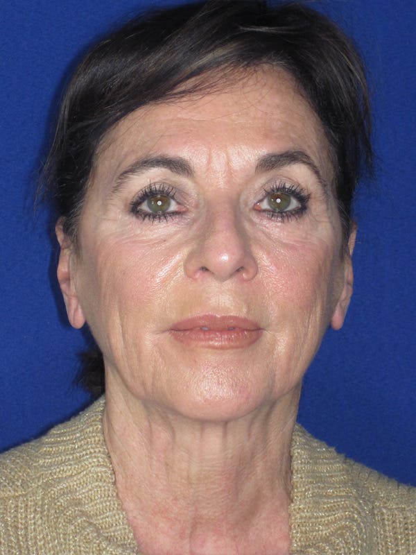 Facelift/Mini-Facelift Before & After Gallery - Patient 165410968 - Image 1