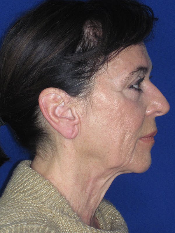 Facelift/Mini-Facelift Before & After Gallery - Patient 165410968 - Image 5