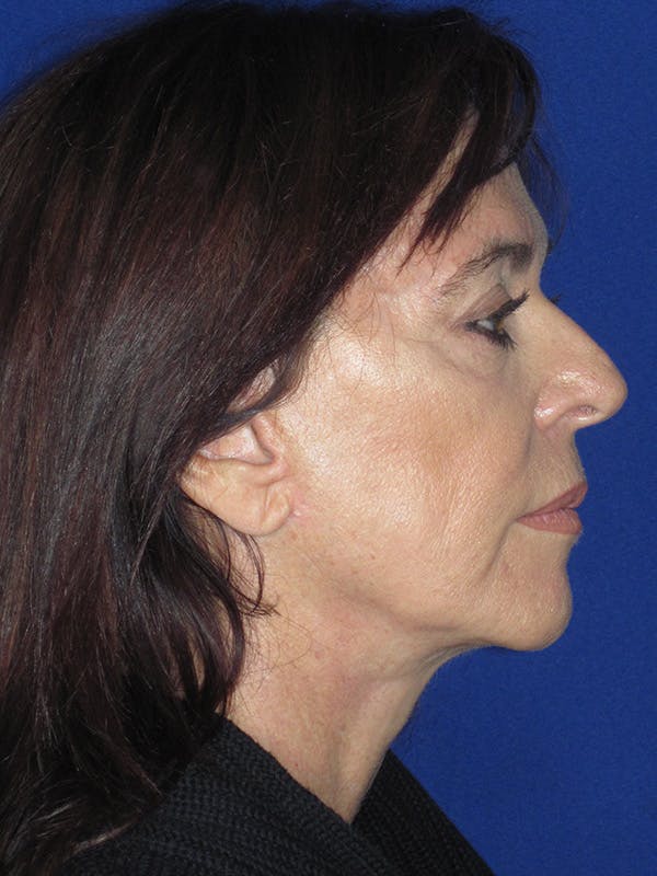 Facelift/Mini-Facelift Before & After Gallery - Patient 165410968 - Image 6