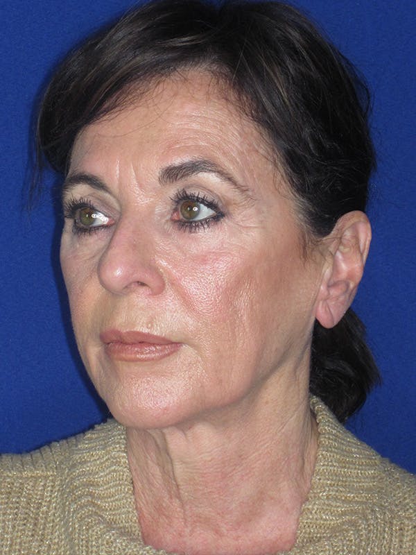 Facelift/Mini-Facelift Before & After Gallery - Patient 165410968 - Image 7