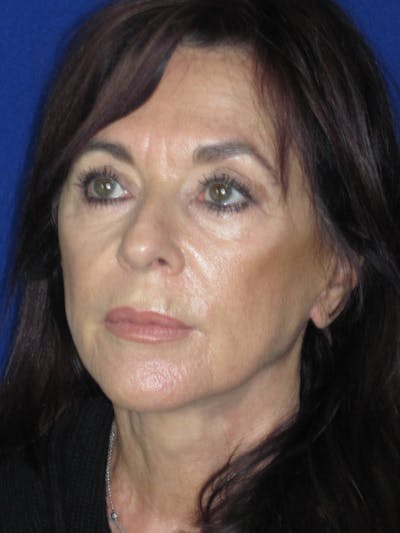 Facelift/Mini-Facelift Before & After Gallery - Patient 165410968 - Image 8