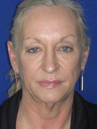 Facelift/Mini-Facelift Before & After Gallery - Patient 165411561 - Image 1