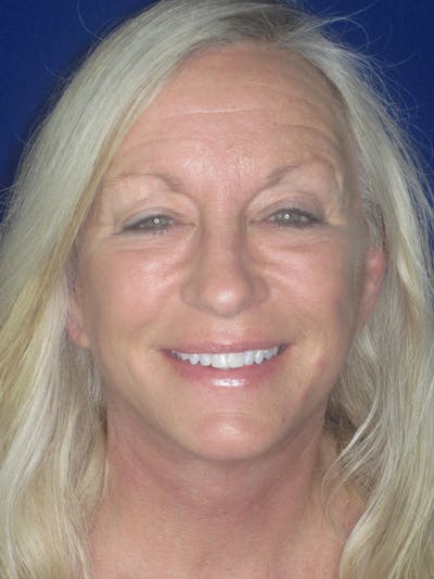 Facelift/Mini-Facelift Before & After Gallery - Patient 165411561 - Image 2