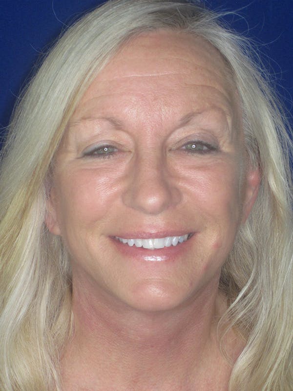 Facelift/Mini-Facelift Before & After Gallery - Patient 165411561 - Image 2