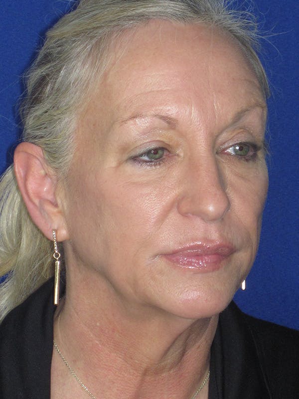 Facelift/Mini-Facelift Before & After Gallery - Patient 165411561 - Image 3