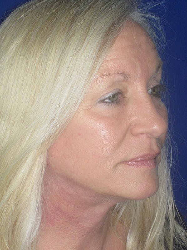 Facelift/Mini-Facelift Before & After Gallery - Patient 165411561 - Image 4