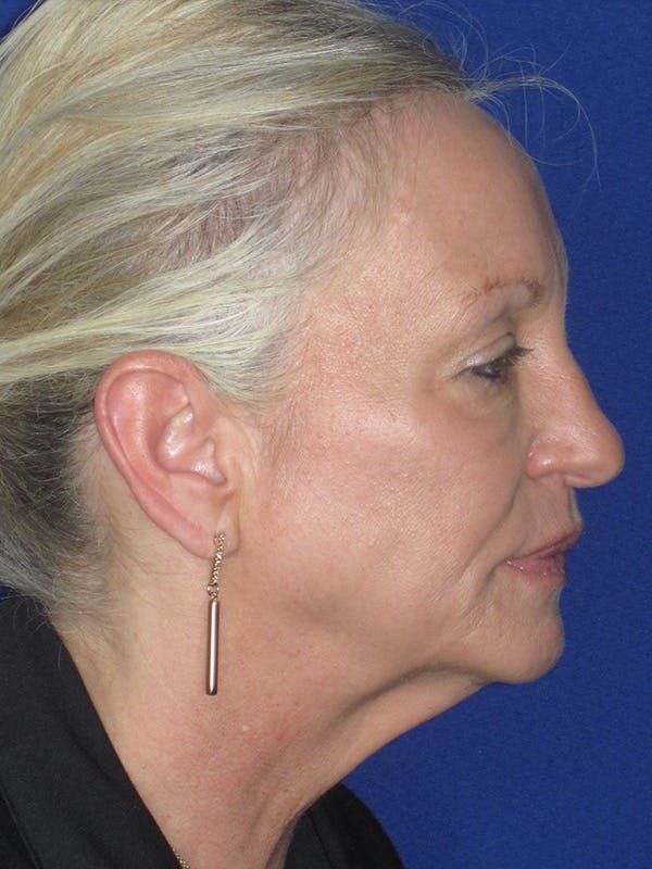 Facelift/Mini-Facelift Before & After Gallery - Patient 165411561 - Image 5