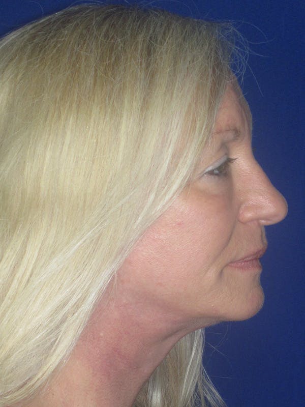 Facelift/Mini-Facelift Before & After Gallery - Patient 165411561 - Image 6