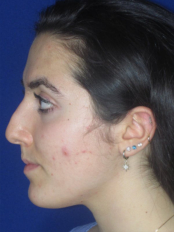 Rhinoplasty Before & After Gallery - Patient 165411575 - Image 5