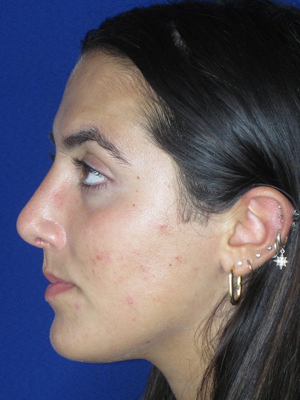 Rhinoplasty Before & After Gallery - Patient 165411575 - Image 6
