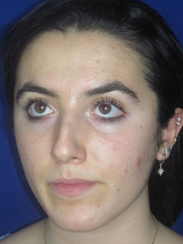 Rhinoplasty Before & After Gallery - Patient 165411575 - Image 3