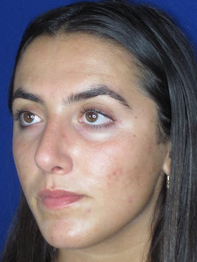 Rhinoplasty Before & After Gallery - Patient 165411575 - Image 4