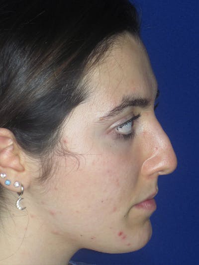 Rhinoplasty Before & After Gallery - Patient 165411575 - Image 1