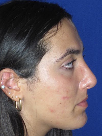 Rhinoplasty Before & After Gallery - Patient 165411575 - Image 2