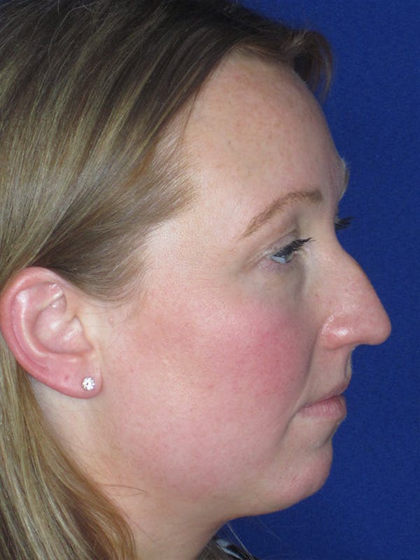 Rhinoplasty Before & After Gallery - Patient 165412510 - Image 1
